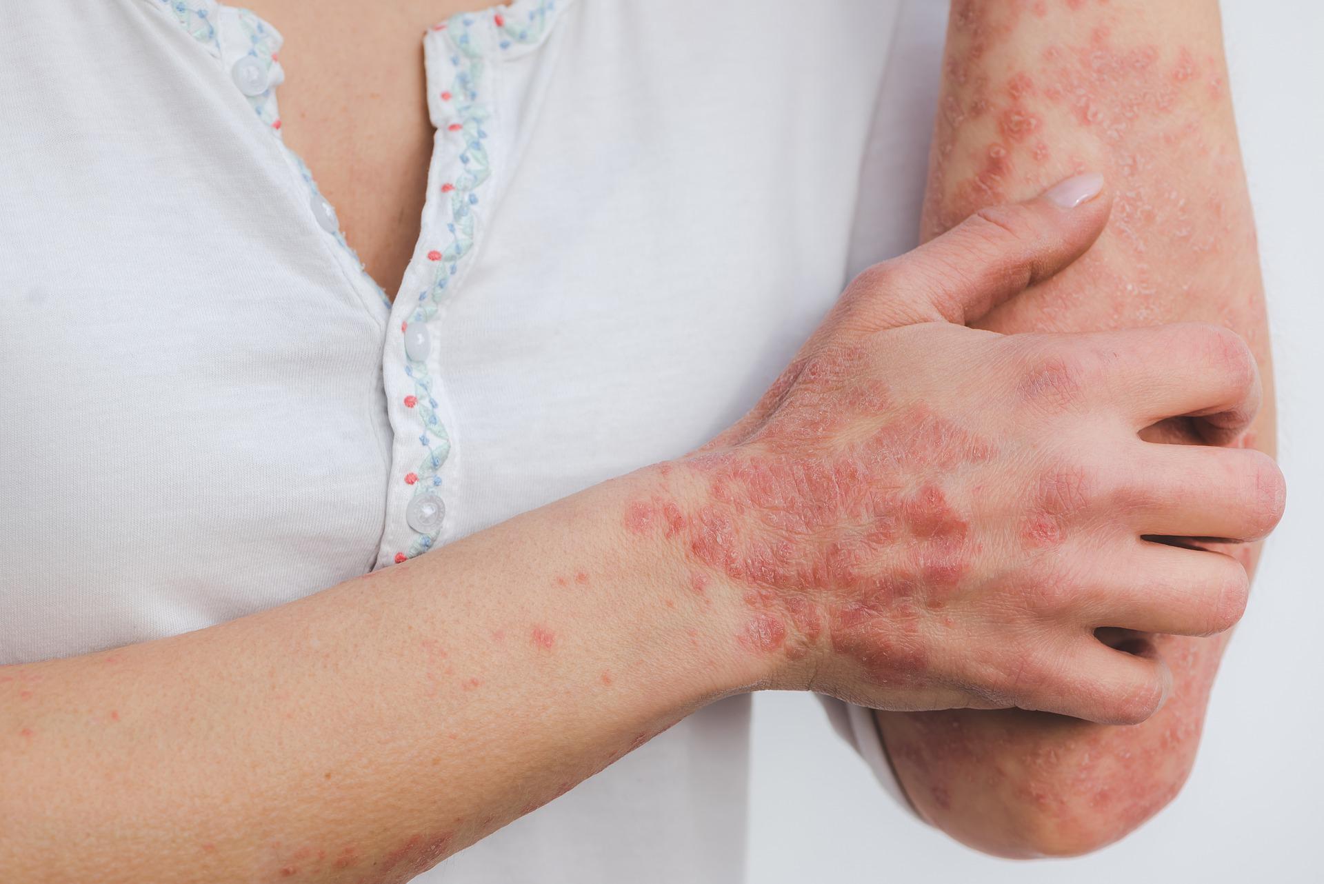 Should I Be Worried About Inflammation?
